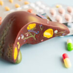 Fatty liver NAFLD