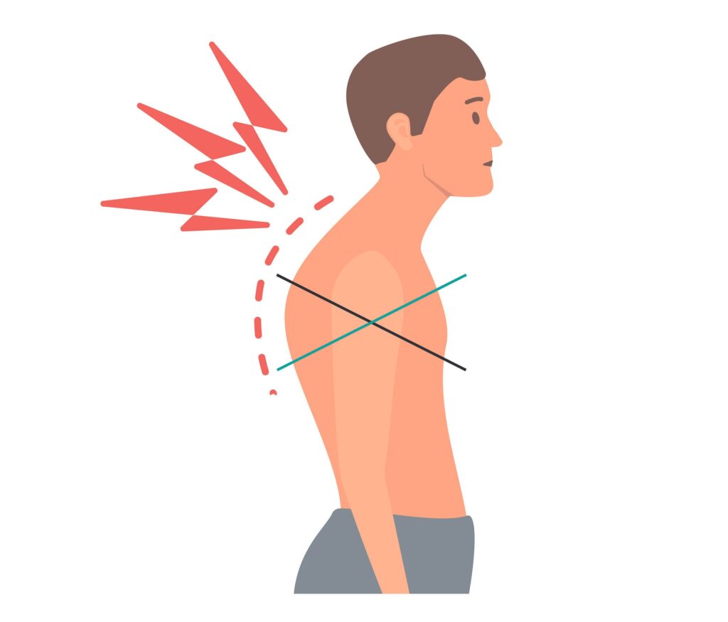 pattern of Upper Cross Syndrome