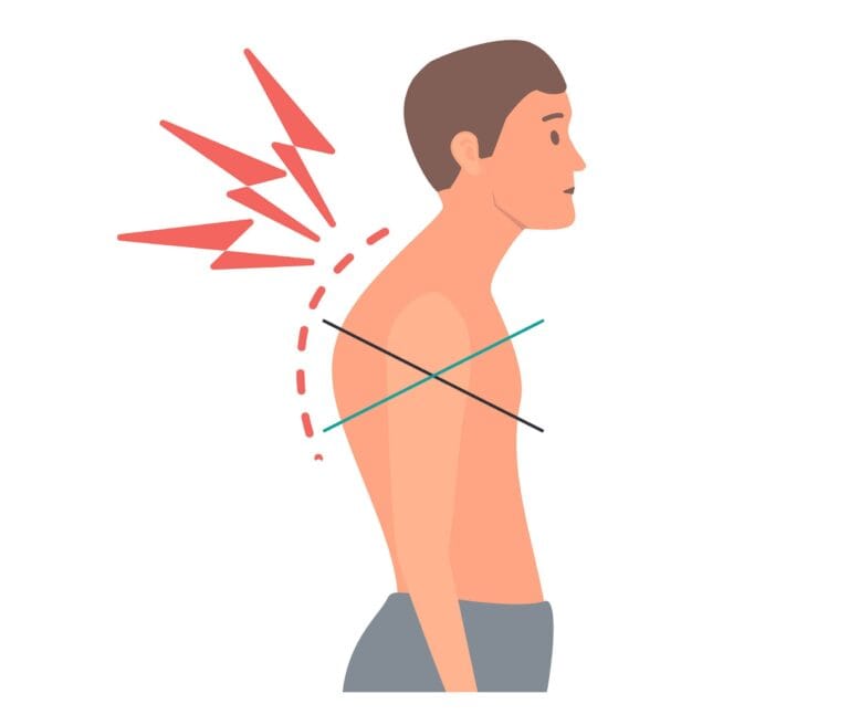 Upper cross syndrome