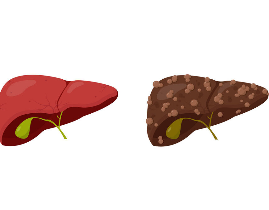 Fatty liver