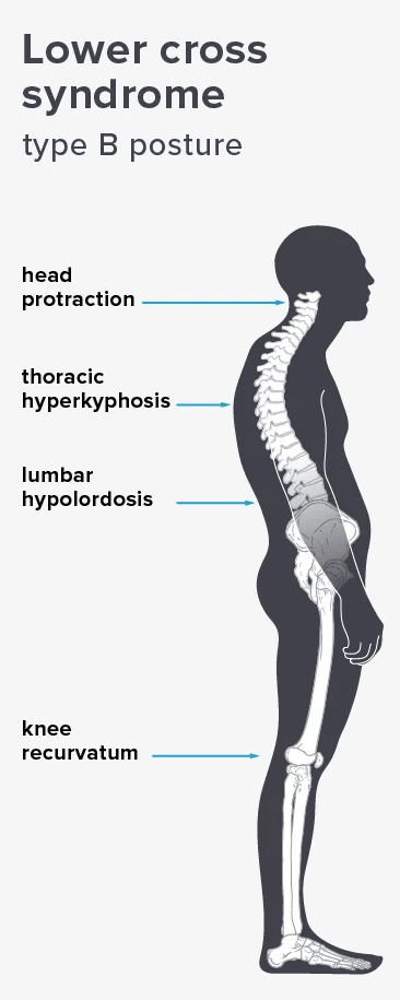 Lower cross syndrome type b