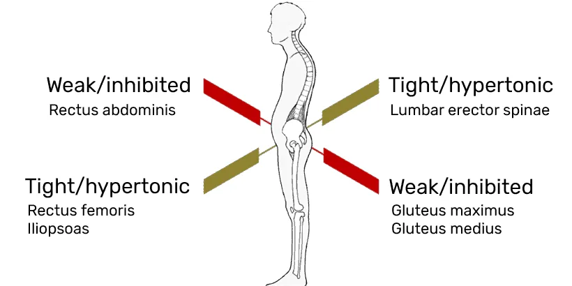 lower cross syndrome