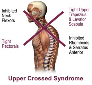 Upper cross syndrome muscles