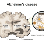 Alzheimer's disease