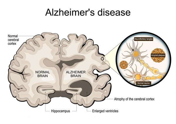 Alzheimer's disease