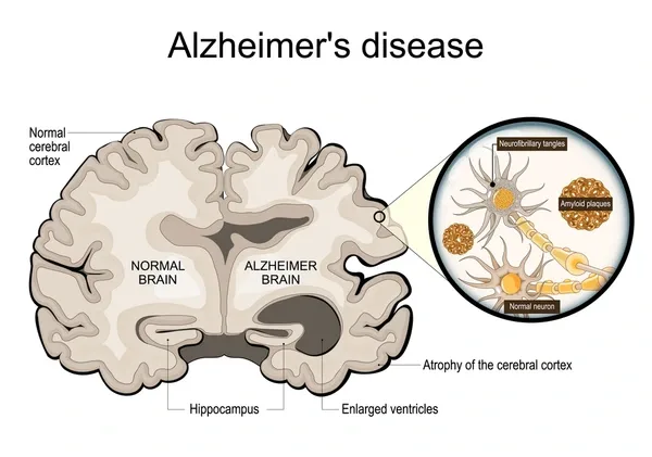 Alzheimer's disease