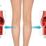 Chronic venous insufficiency