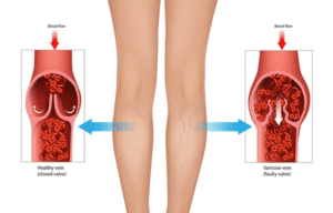 Chronic venous insufficiency