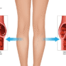 Chronic venous insufficiency