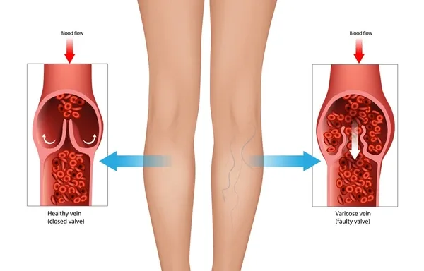 Chronic venous insufficiency